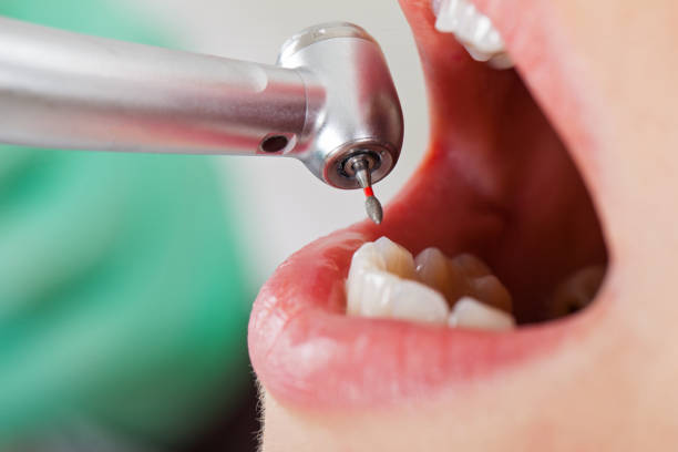 Best Emergency Dental Care for Broken or Chipped Teeth in Frankfort, IN